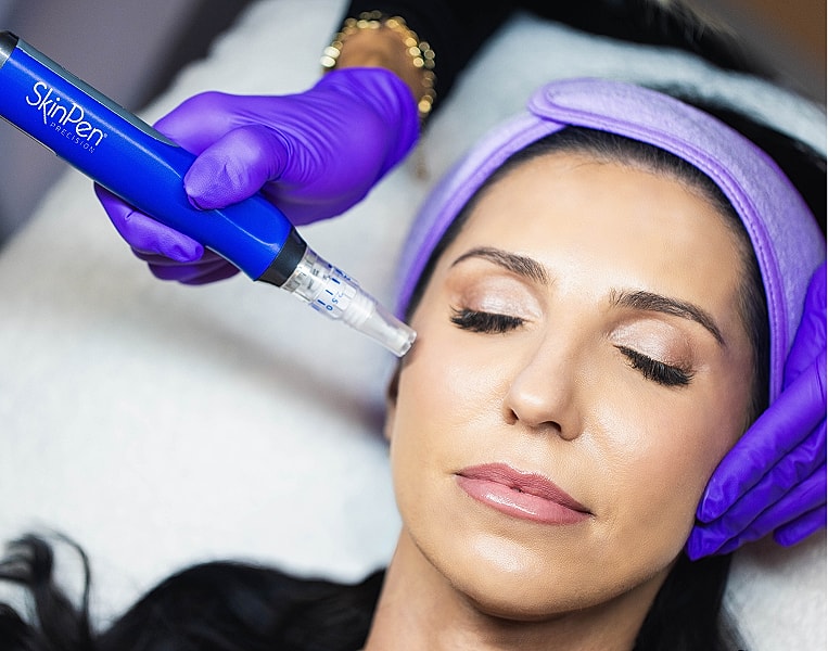 Microneedling treatment with SkinPen device on face.